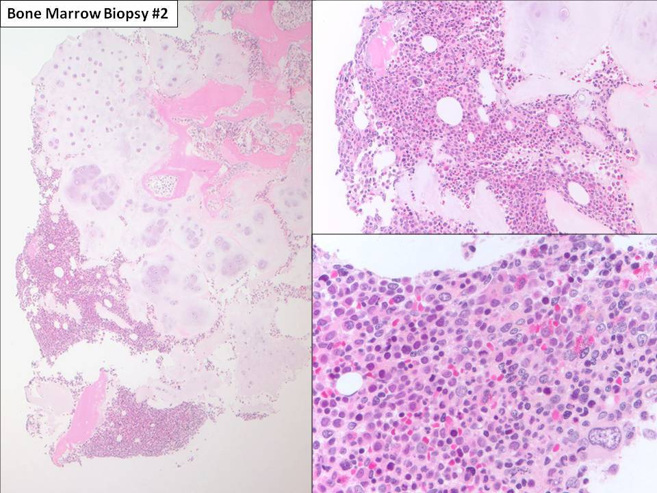 Bone marrow biopsy #2: The bone marrow appears hypercellular in small amount of marrow present.